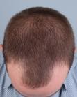 Before Hair Transplant&nbsp;Front